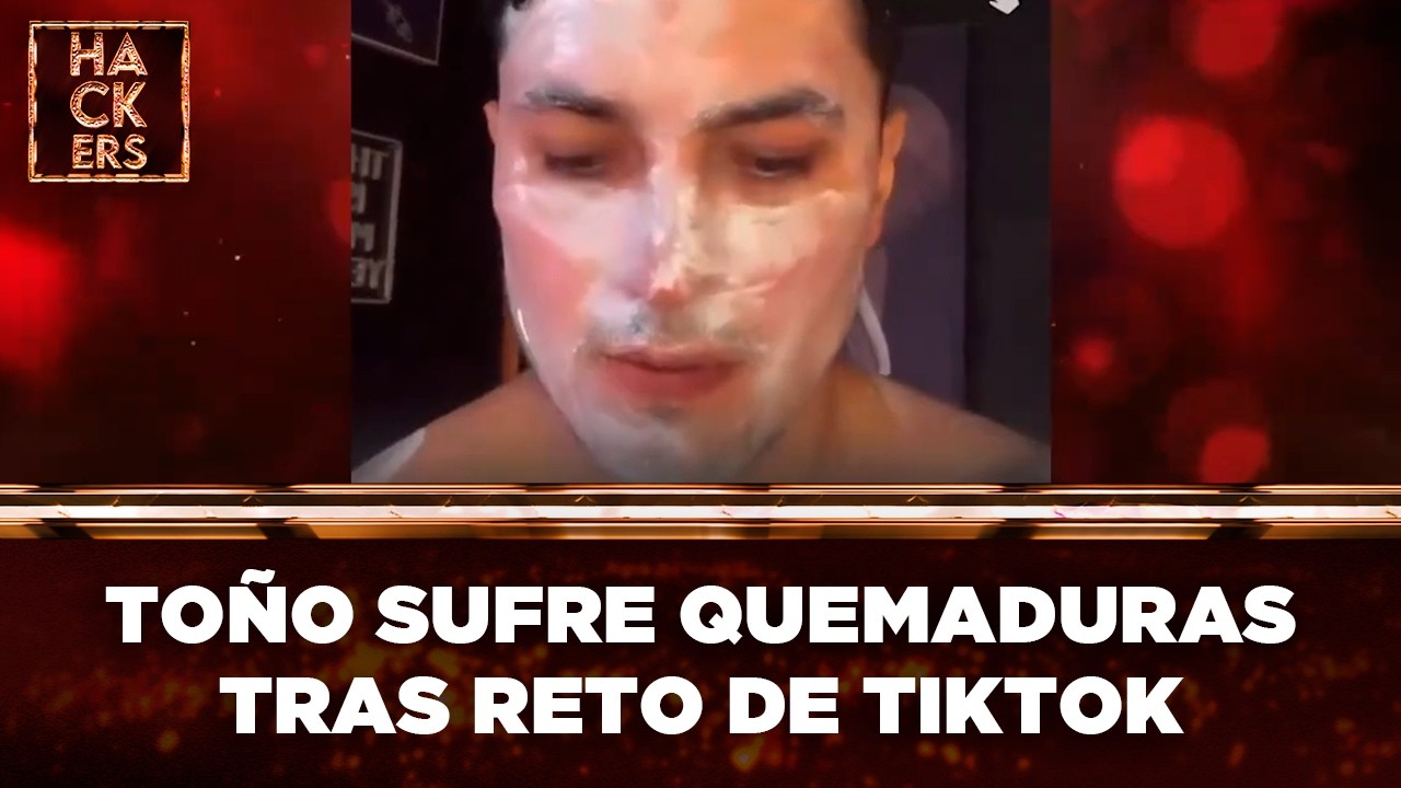 Toño Abril sufrió terribles quemaduras en el rostro tras un reto de TikTok | LHDE | Ecuavisa