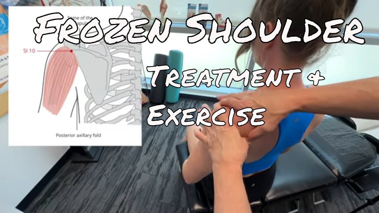Замороженное плечо — лечение и упражнения