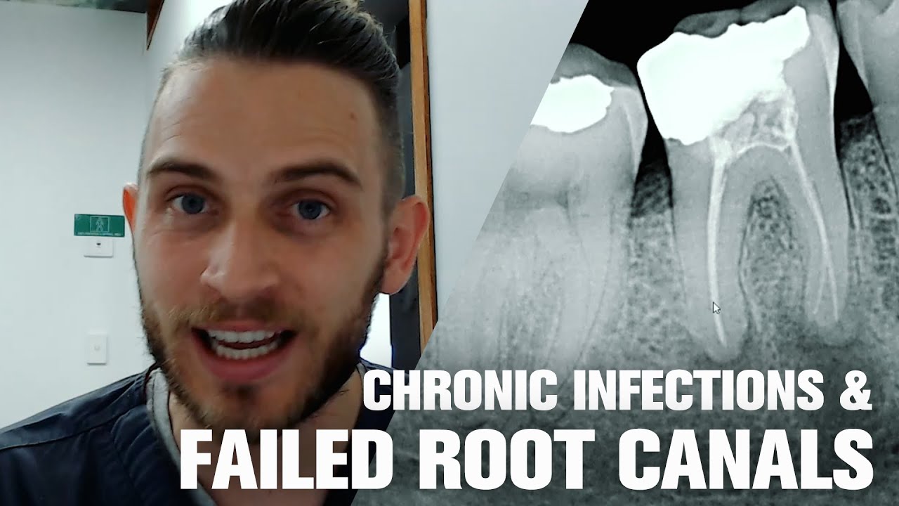 Dentist reveals - How To Tell If You Have Chronic Tooth Infection