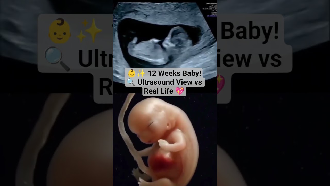 👶✨ 12 Weeks Baby!🔍 Ultrasound View vs Real Life 💖 #ultrasound #baby
