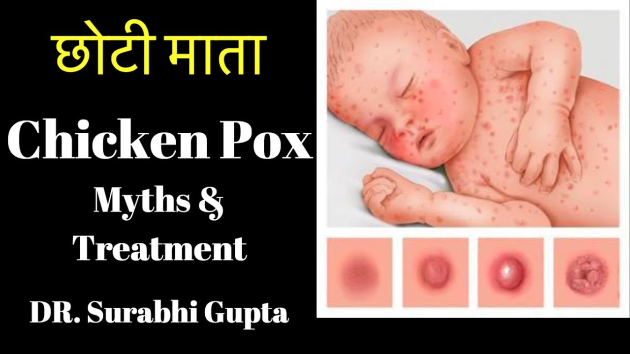 Chicken Pox  Symptoms, Treatment, Prevention, Myths & complications
