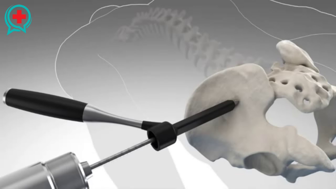 Stabilizzazione sacroiliaca