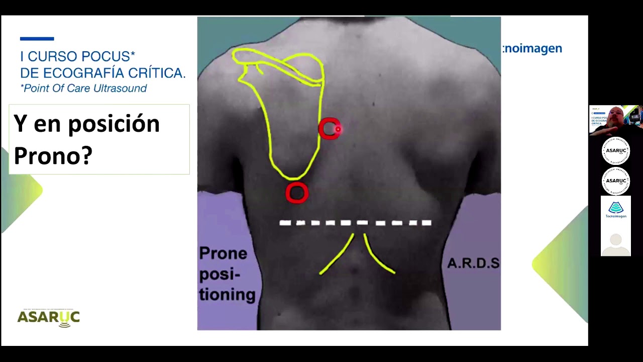 Ecografia Pulmonar en el POCUS