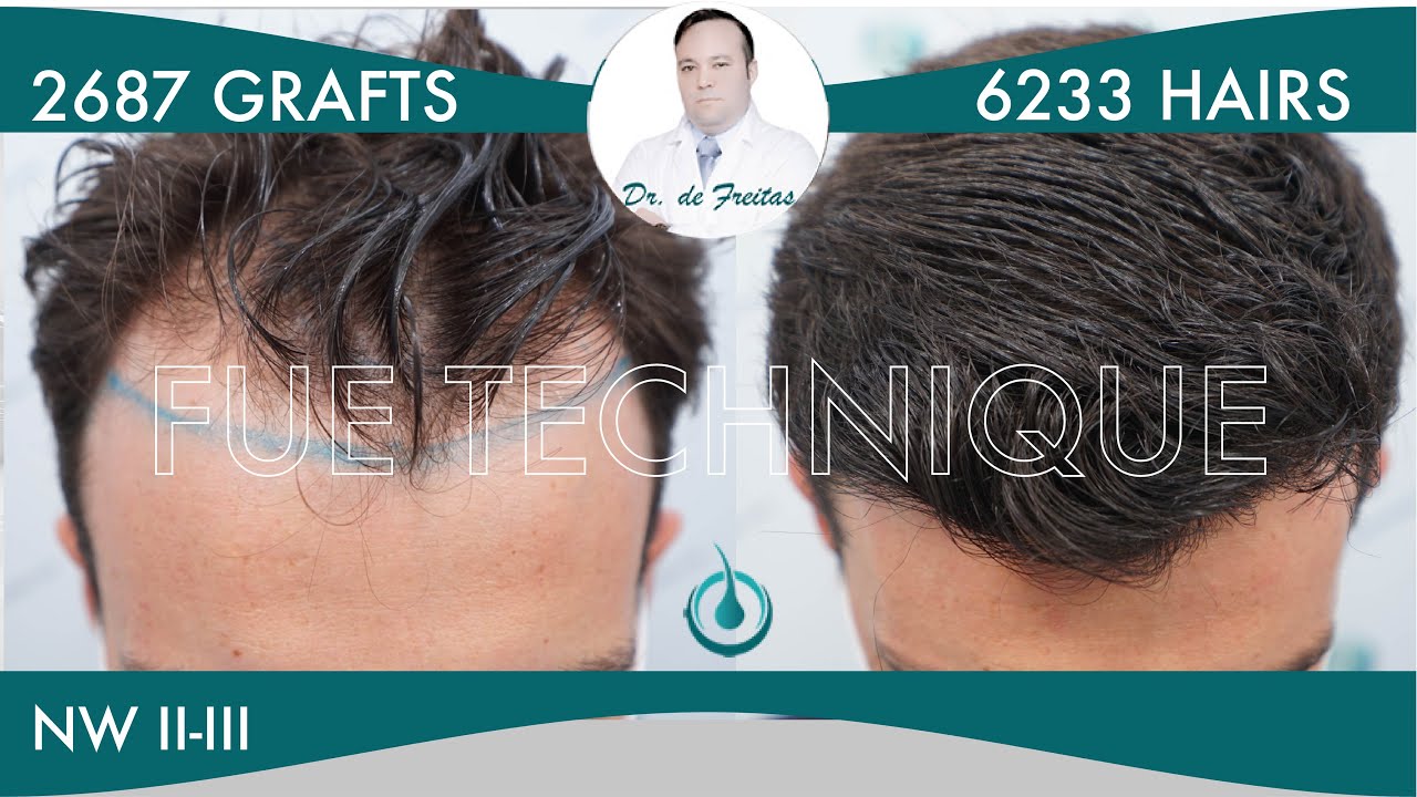 Hair Graft Technique FUE - 2687 Grafts (6233 Hairs) - Dr. Rafael de Freitas