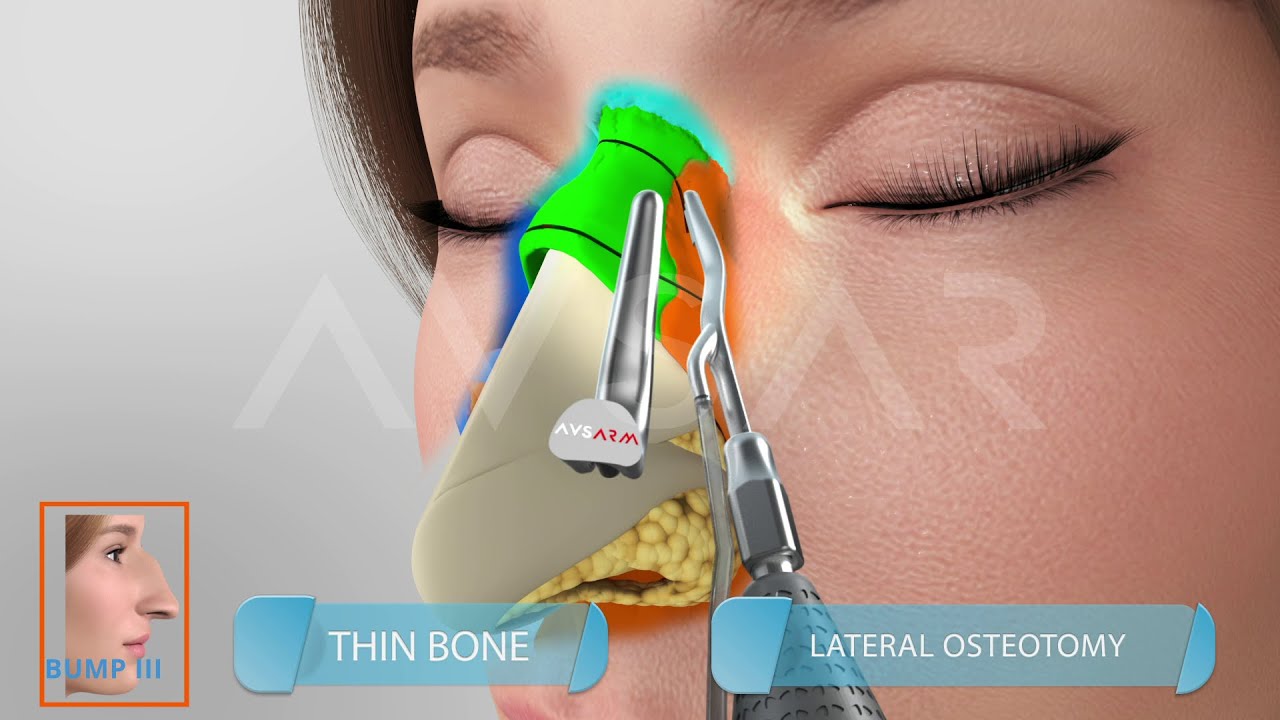Dr. Yakup Avsar Double Push Down Technique