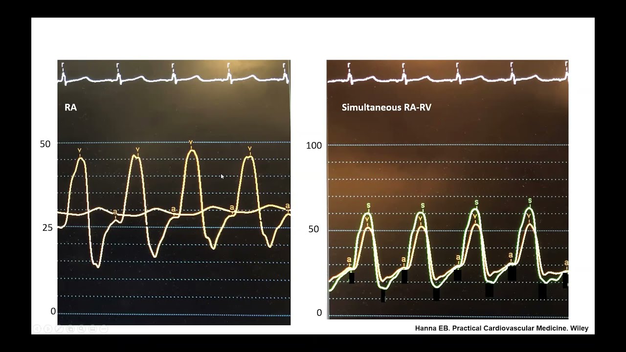 Hemodynamic cases: tricuspid regurgitation, aortic and pulmonic insufficiency - Elias Hanna