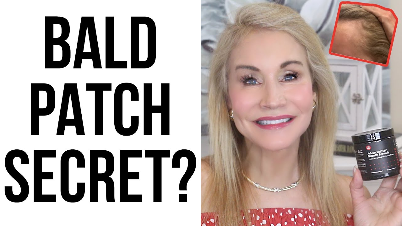 BALD PATCHES? DOES ANYTHING WORK? GREAT STUDY!