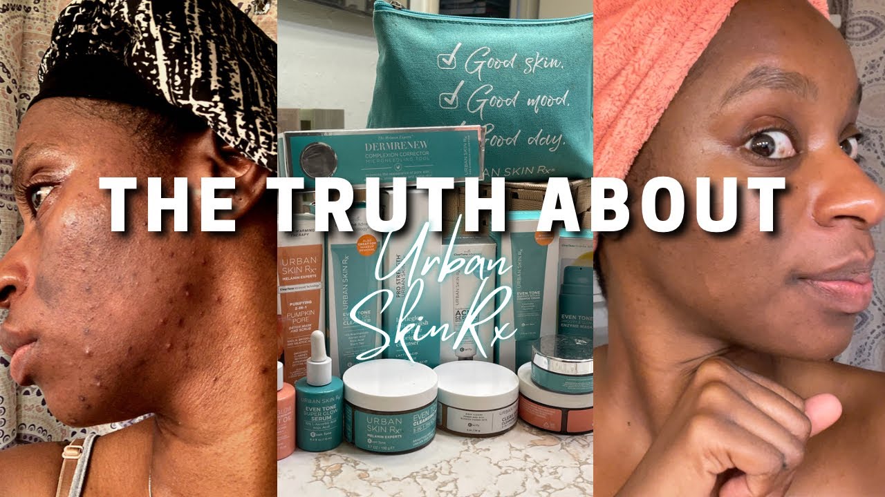 My Face Got Burned | Clearing Dark Spots | UrbanSkinRx Review