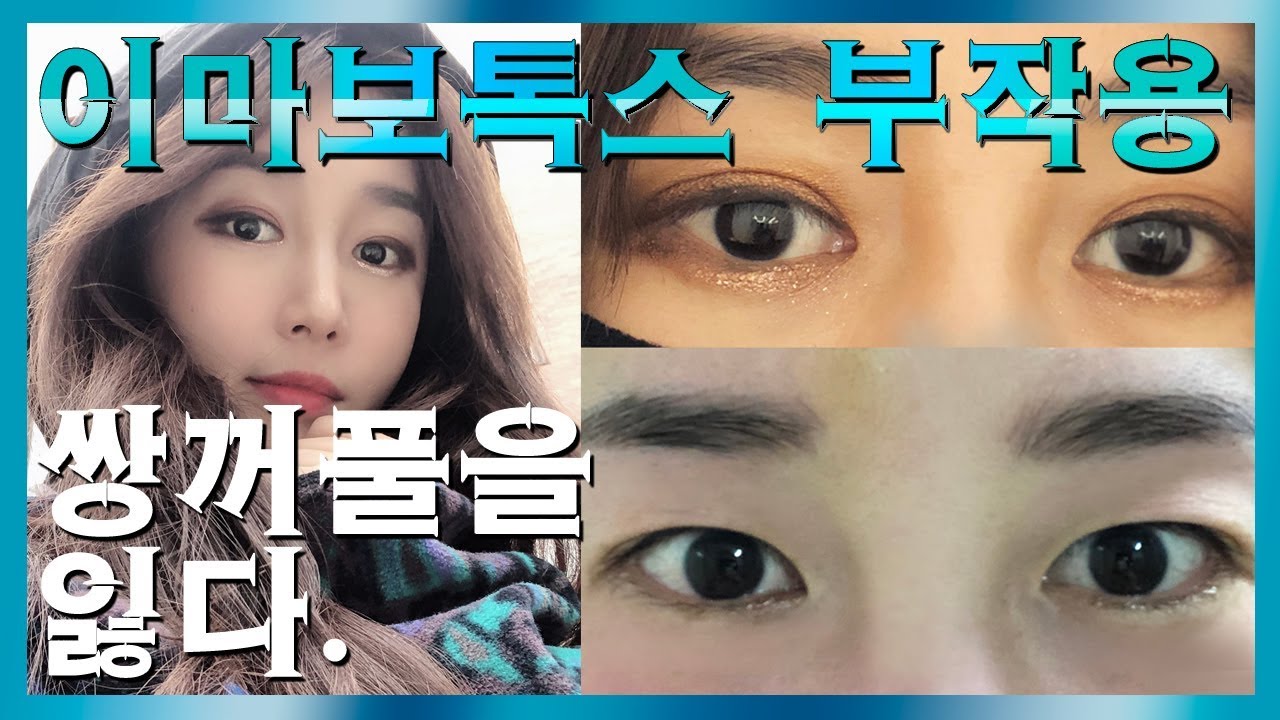 미간&이마 보톡스 부작용으로 쌍꺼풀을 잃었습니다 [부작용사진 추가]