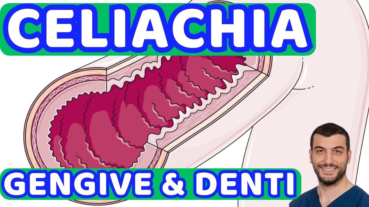 Effetti della Celiachia a Denti e Gengive? Sintomi e 3 consigli per la Prevenzione