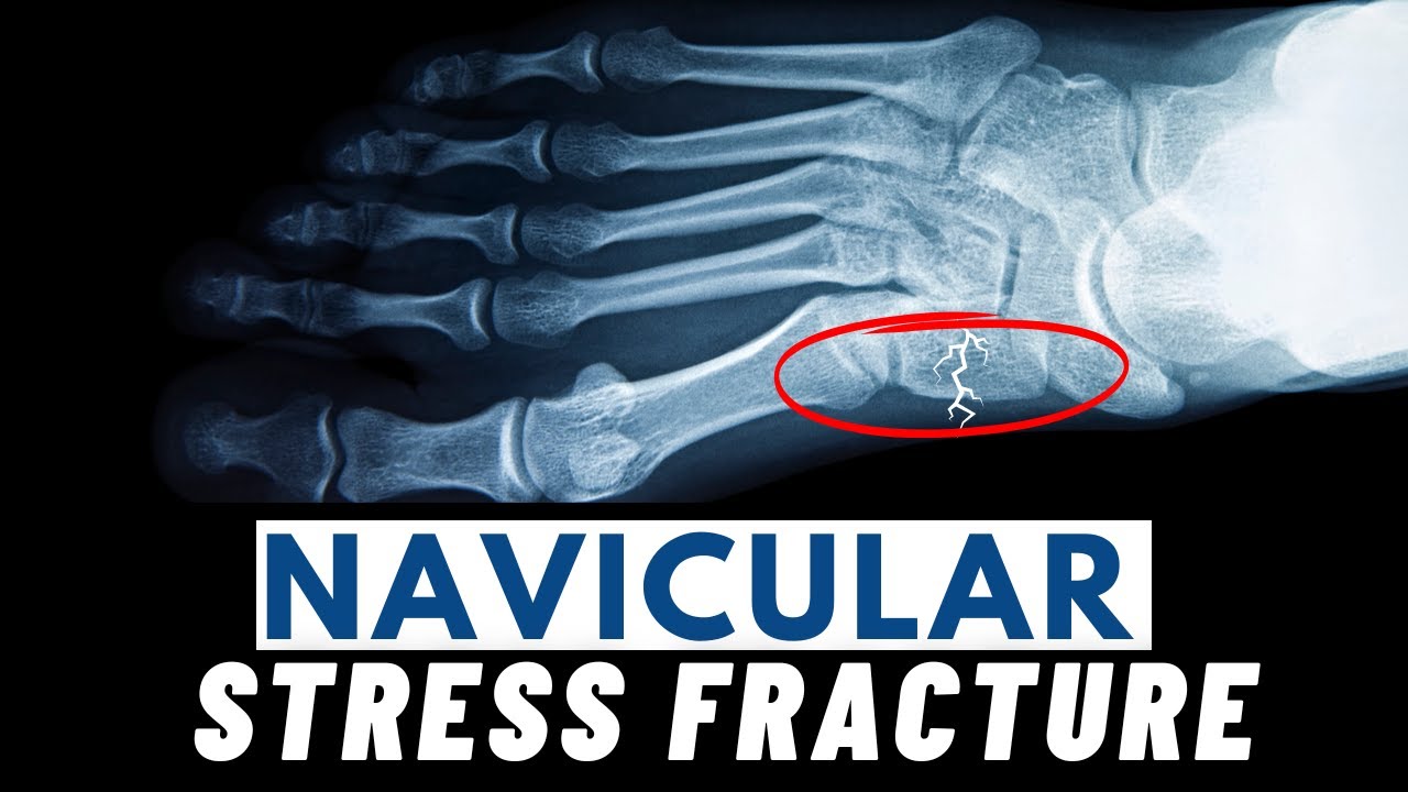 Navicular Stress Fractures | Symptoms, Causes, Diagnosis & Treatment