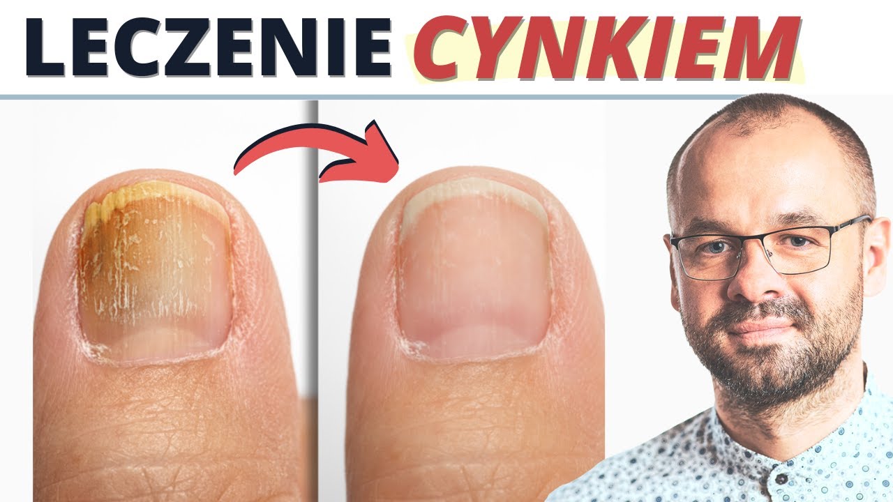 Cynk pomaga leczyć 20 chorób. Sprawdź które.