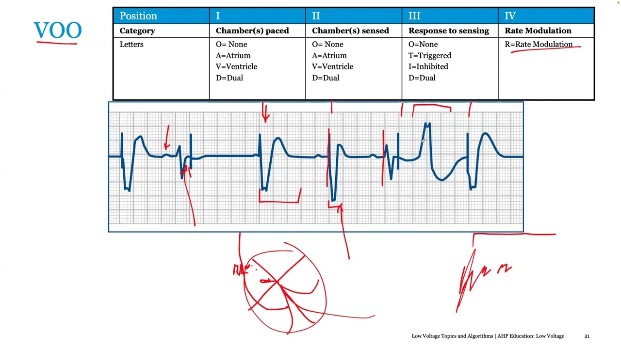 Pacemaker Mode Selection and 12 Lead ECG Interpretation of STEMI - Port Harcourt Pacing