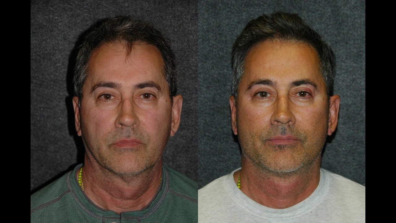 Facelift for Men Natural Before and After on 59 Year Old Man | #faceliftformen