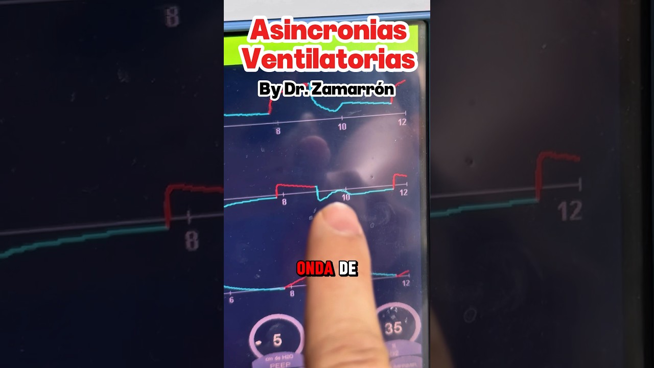 &iquest;Asincron&iacute;a en el ventilador? As&iacute; la detectas y corriges en segundos 🩺🔧 #emergencias #aventho #uci