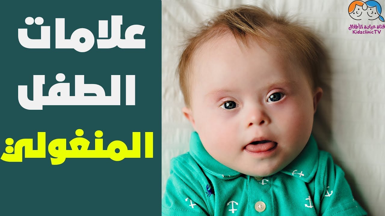كيفية معرفة الطفل المنغولي او متلازمة داون - دليل شامل للطفل المنغولي