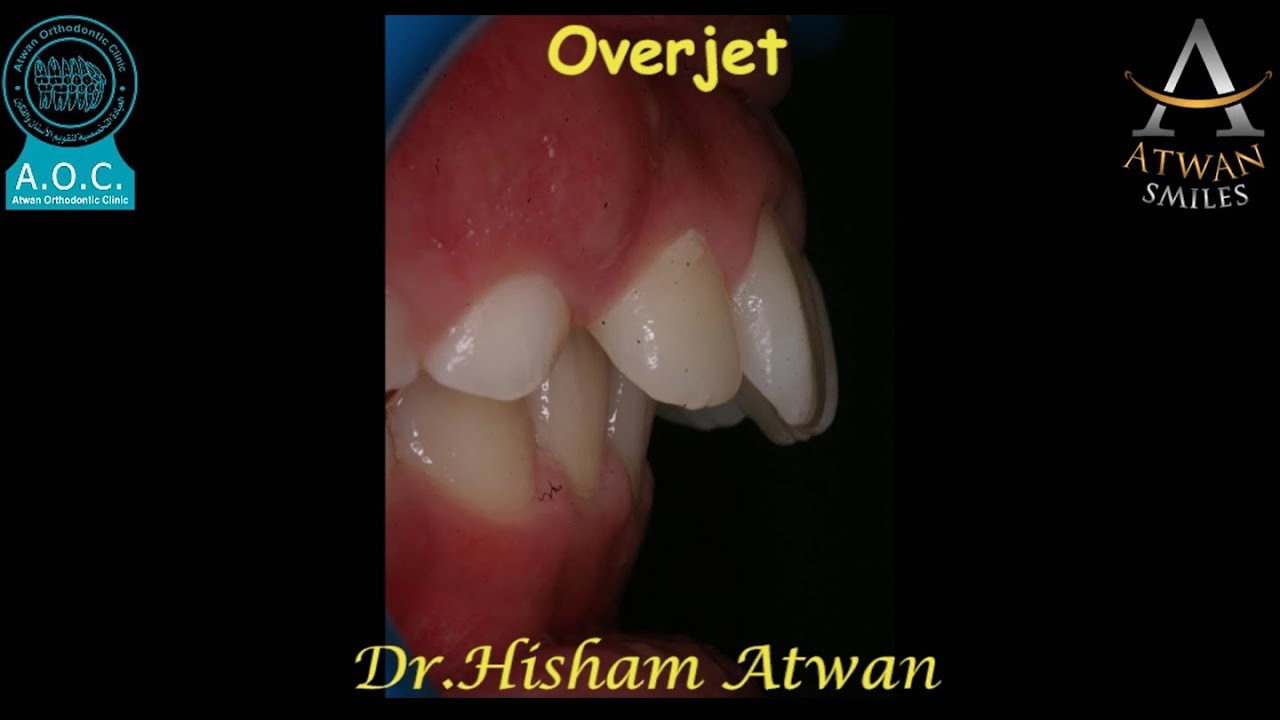 Amazing Class ll treatment by early elastics & Anterior Bite Raisers