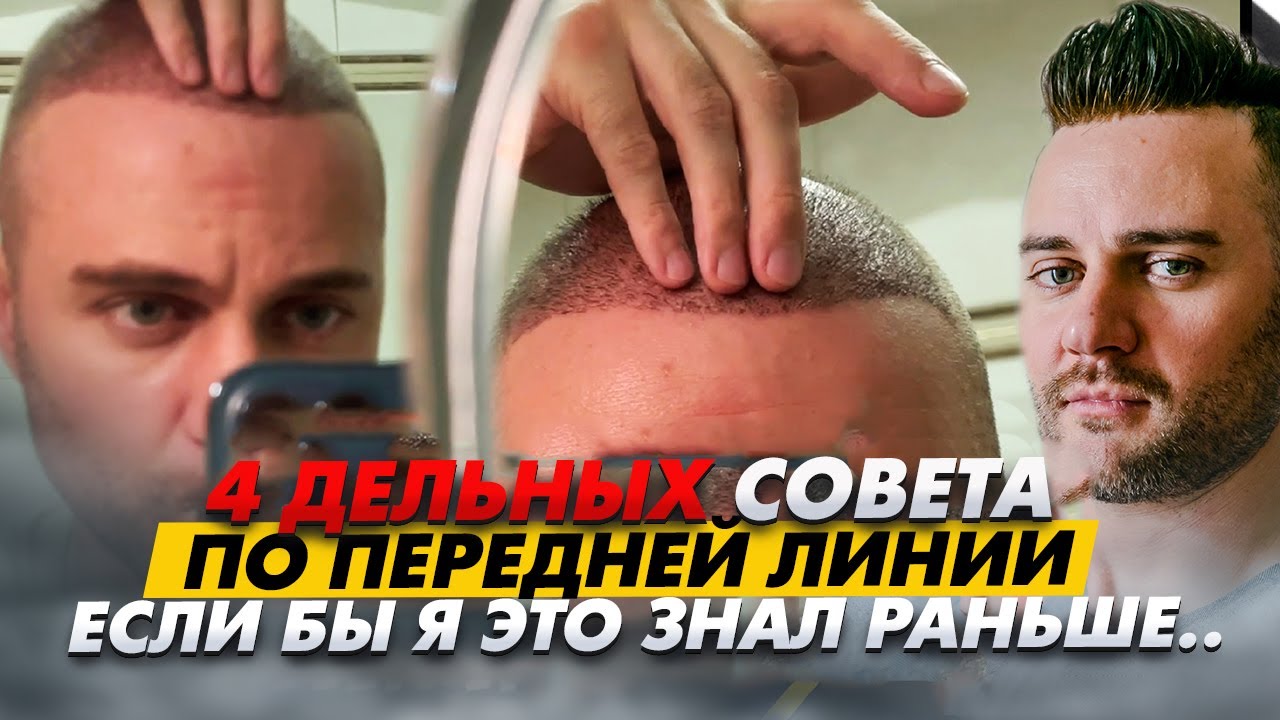 ВАЖНО: 4 совета по линии роста волос перед операцией по пересадке / Красавчик