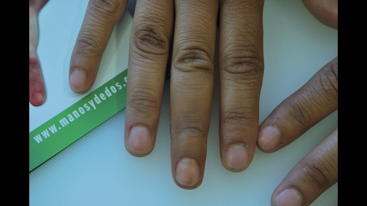 Prótesis para dedos, (finger prosthesis) No.100