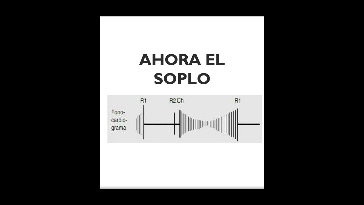 ESTENOSIS MITRAL SOPLO. As&iacute; se escucha! #cardiology #cardio