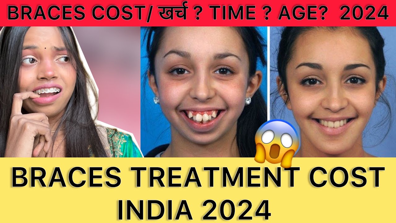 BRACES treatment - cost / खर्च ? 2024 | to itne saalon baad treatment start hua🥲| DENTAL BRACES |