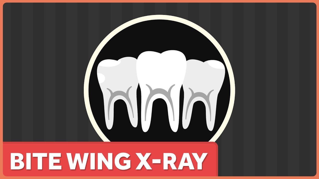 Going to the Dentist? You Might Not Need Those Bite Wing X-Rays