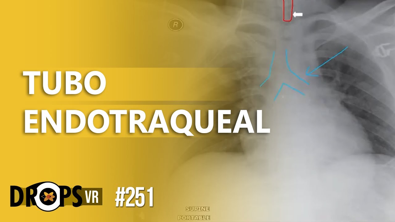 TUBO ENDOTRAQUEAL MAL POSICIONADO NA UTI