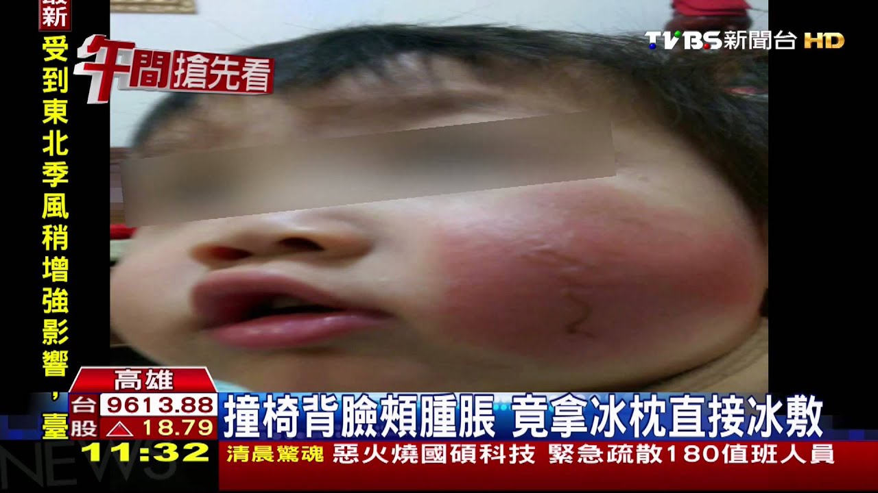 ​男童撞傷變凍傷　錯誤冰敷臉腫1倍大