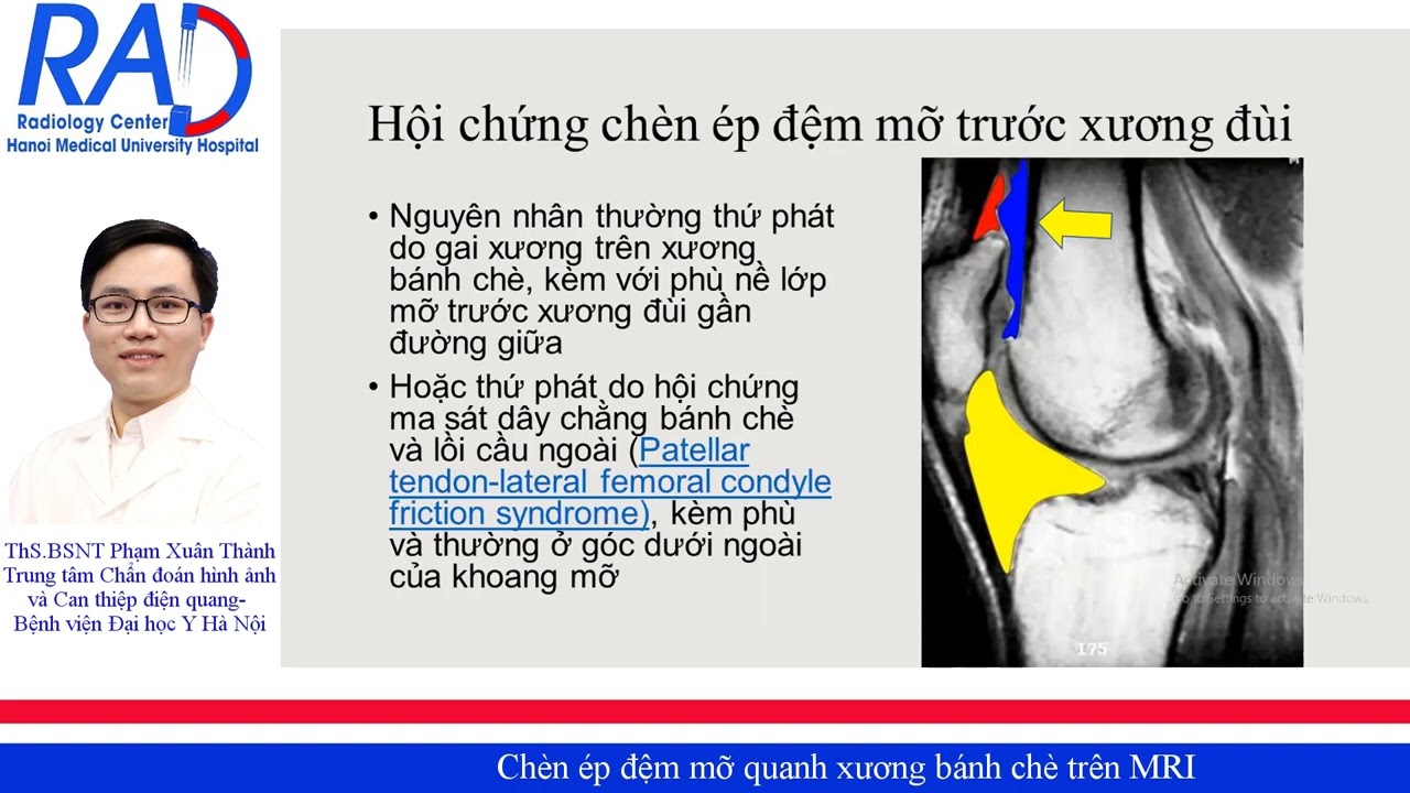 Chèn ép đệm mỡ quanh xương bánh chè trên MRI (Peripatelarr Fat Pad Impingement)