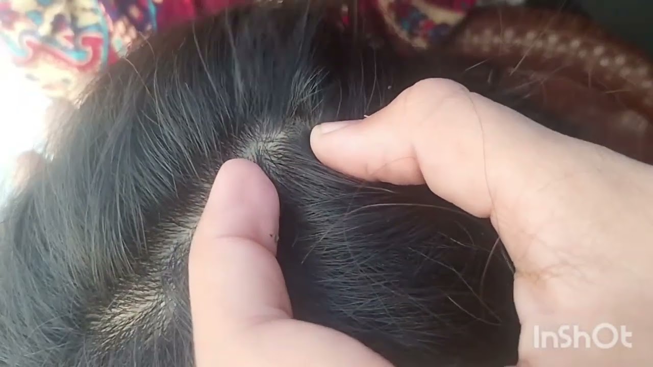 Daily checking lice 
