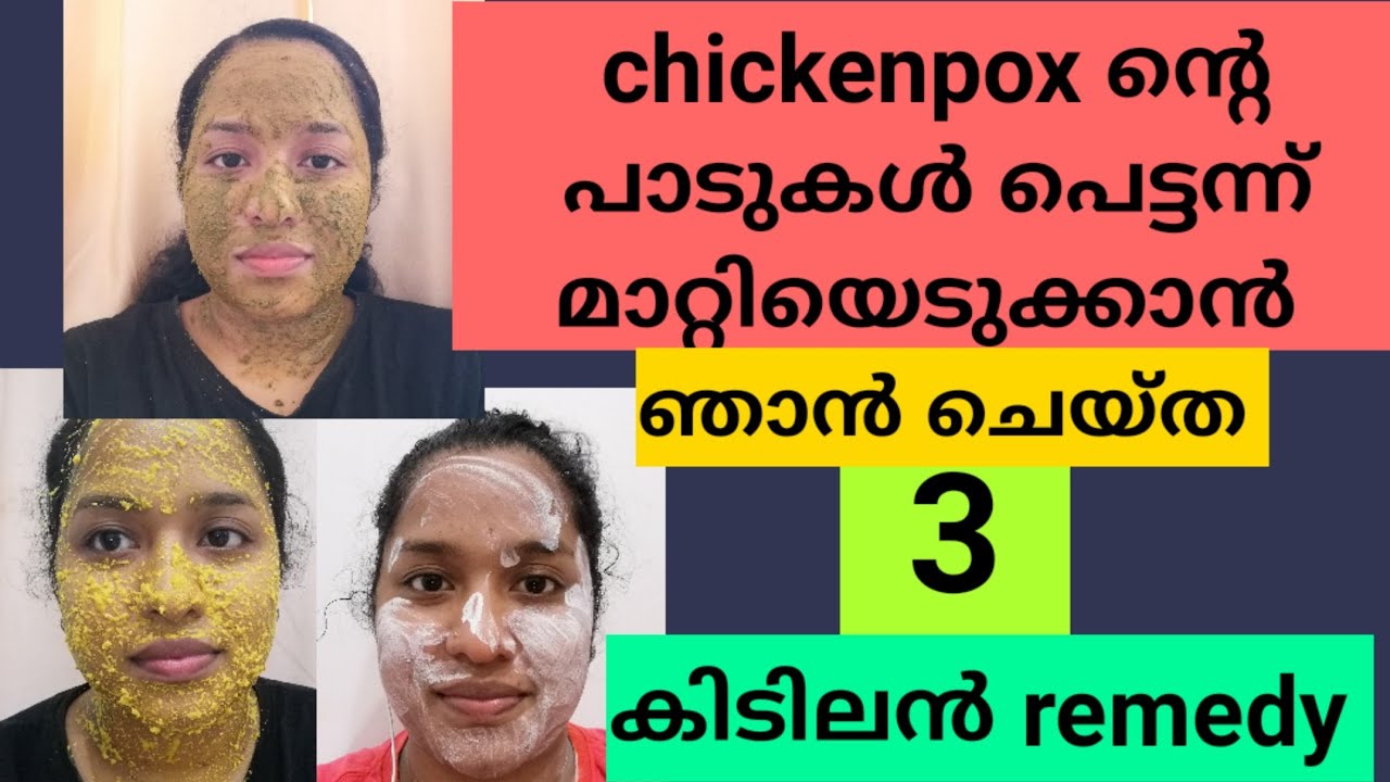 BEST 3 REMEDY FOR CHICKENPOX MARKS/malayalam/motherhood/