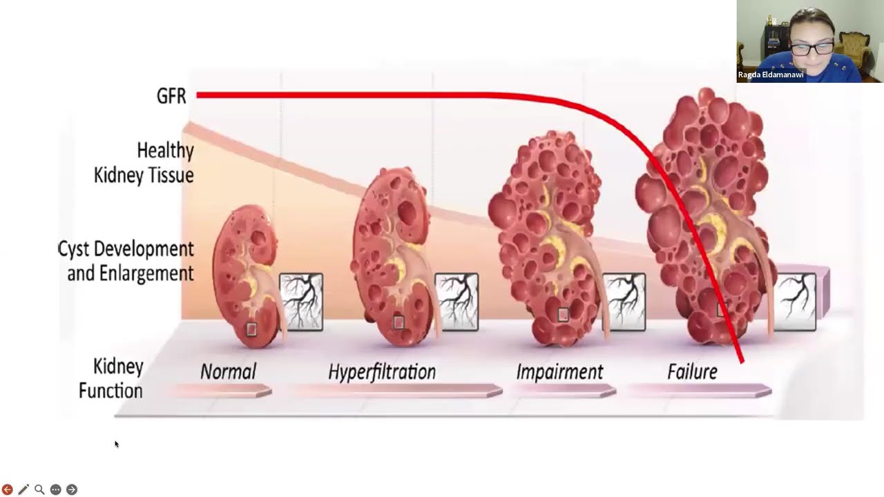 IMPEDE-PKD Clinical Trial and Background Information - Q&A, November 2025