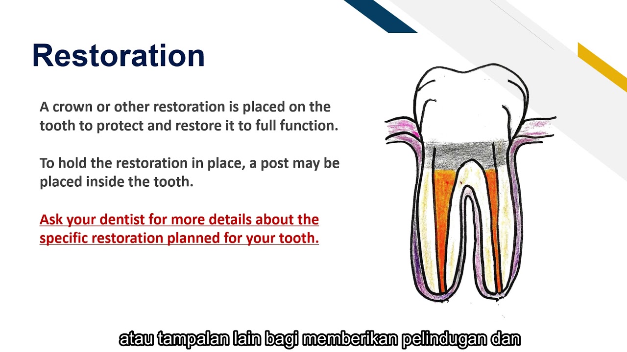 Root canal Treatment (RCT) and Post & Core 2