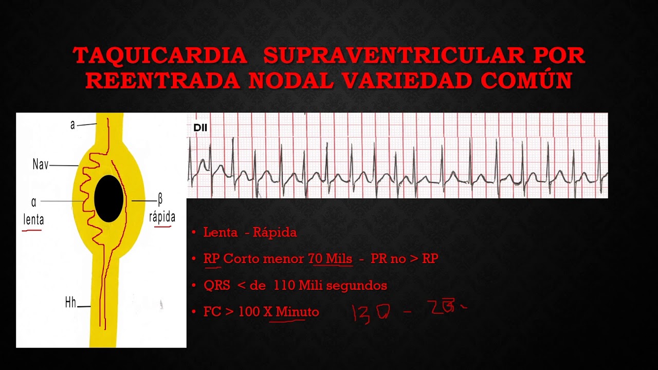 21. TAQUICARDIA SUPRAVENTICULAR POR REENTRADA NODAL
