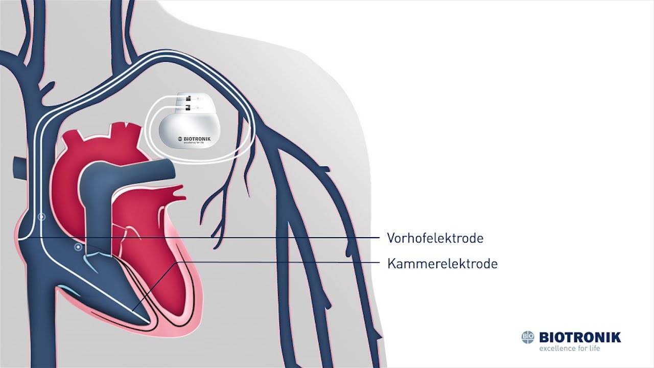 Herzschrittmacher: Aufbau & Funktion (Animation Medizin)
