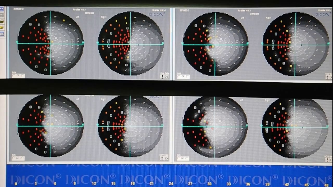 RECUPERACIÓN CAMPO VISUAL CENTRAL EN UN PACIENTE HEMIANÓPSICO