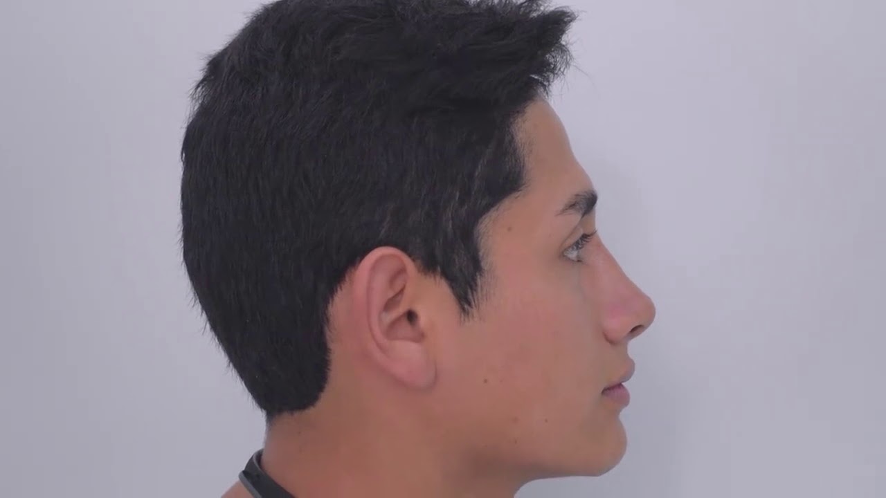 Rinoplastia estética - Antes y después - Dr. César Calderón Cirujano Plástico