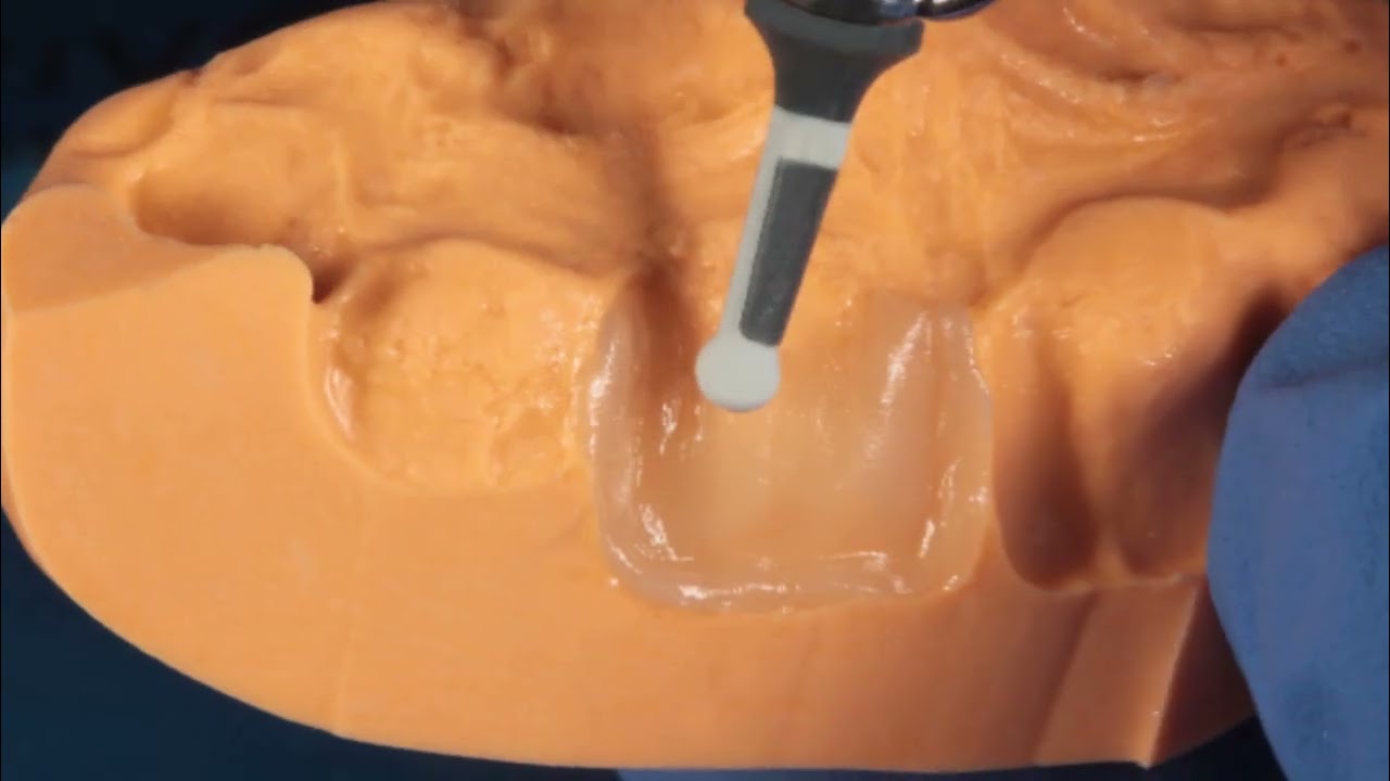 RESINAS ANTERIORES CON BRILLIANT EVER GLOW