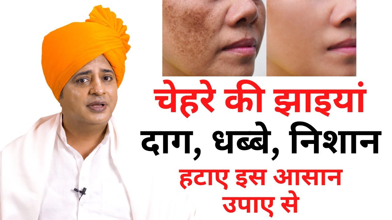 Eliminate facial freckles and melasma from the root || Sanyasi Ayurveda ||