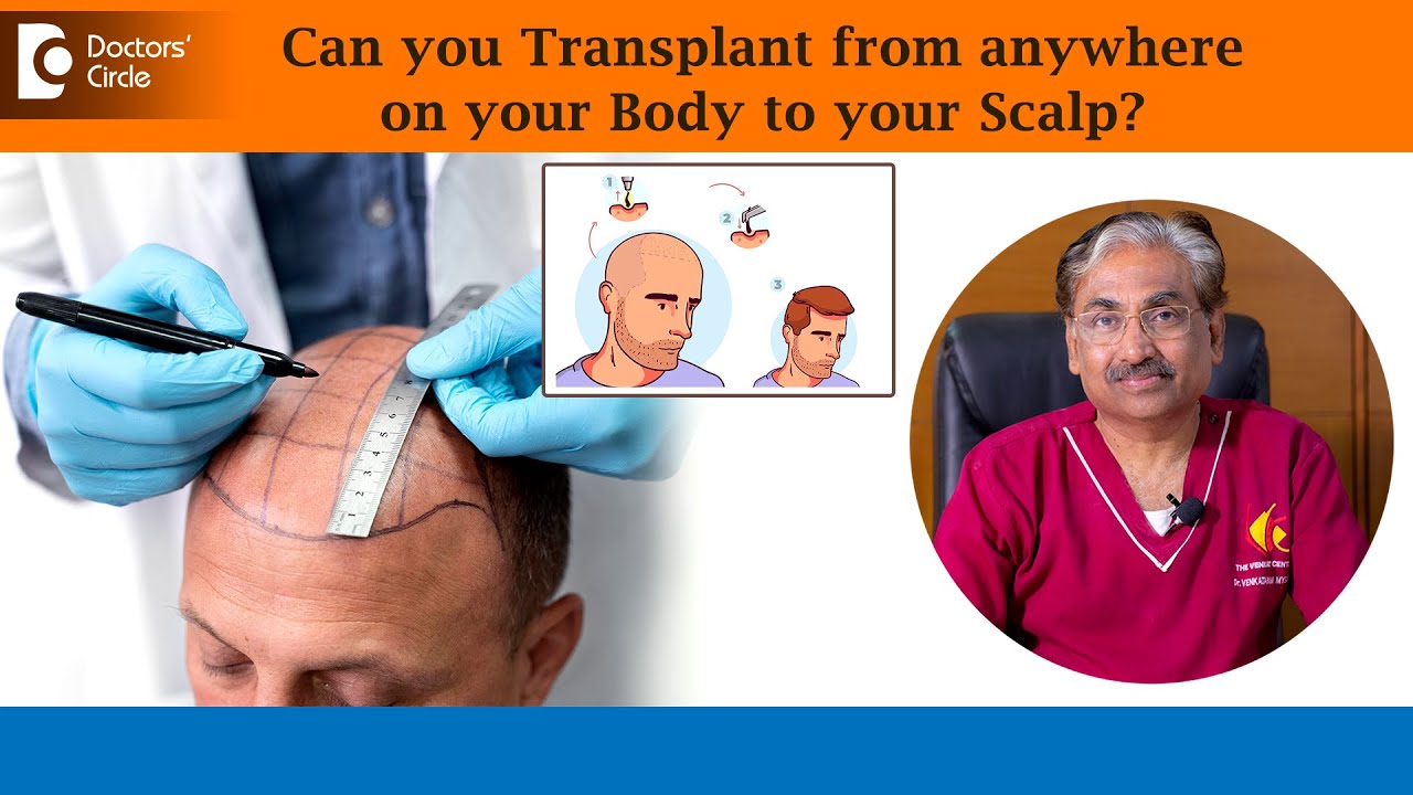 Beard or Body Hair to Scalp | BODY HAIR TRANSPLANT for Baldness-Dr.Venkataram Mysore|Doctors' Circle