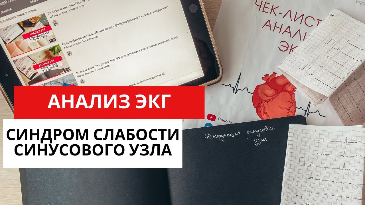 Синдром слабости синусового узла (СССУ-дисфункции синусового узла). ЭКГ. Причины. Симптомы.
