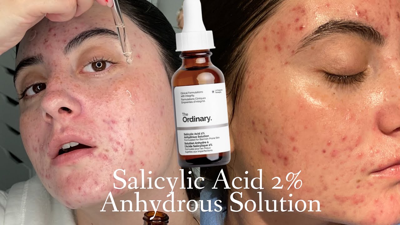 TESTING THE ORDINARY SALICYLIC ACID 2% ANYDROUS SOLUTION FOR 3 WEEKS ON HORMONAL ACNE SKIN