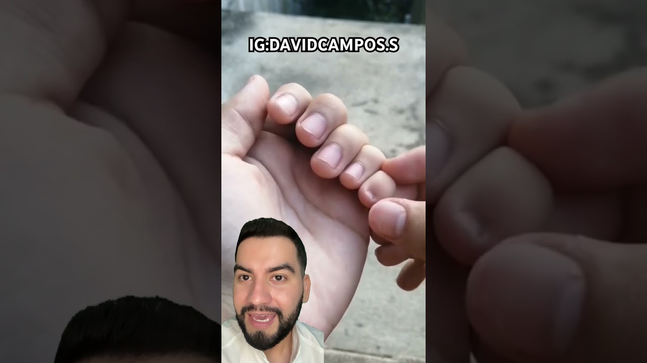 TIENE 6 DEDOS #polidactilia
