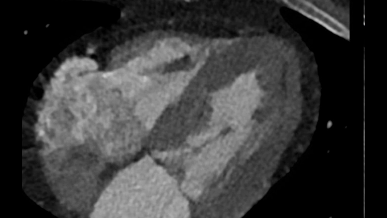 subendocardial myocardial infarction