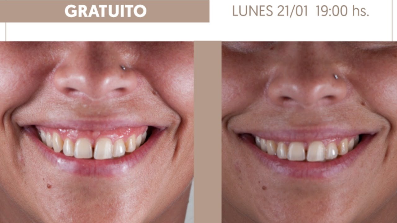 Sonrisa Gingival- Tratamiento simple y predecible