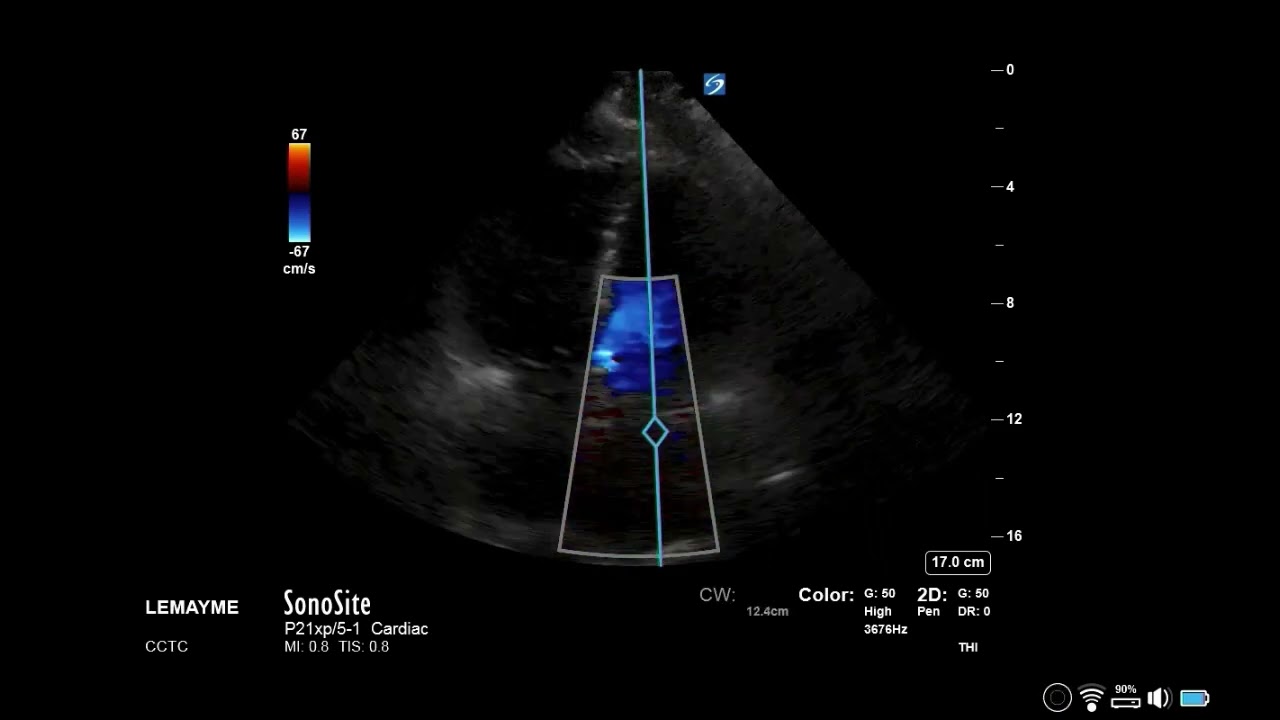 How to...Measure MVA using PHT or Deceleration Time