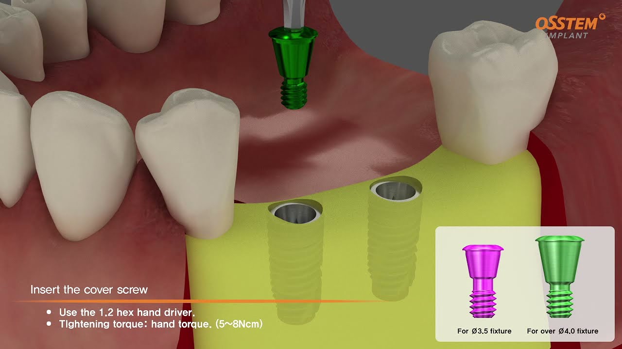 Osstem - TSIII fixture with Transfer Abutment Surgical & Prothesis sequence