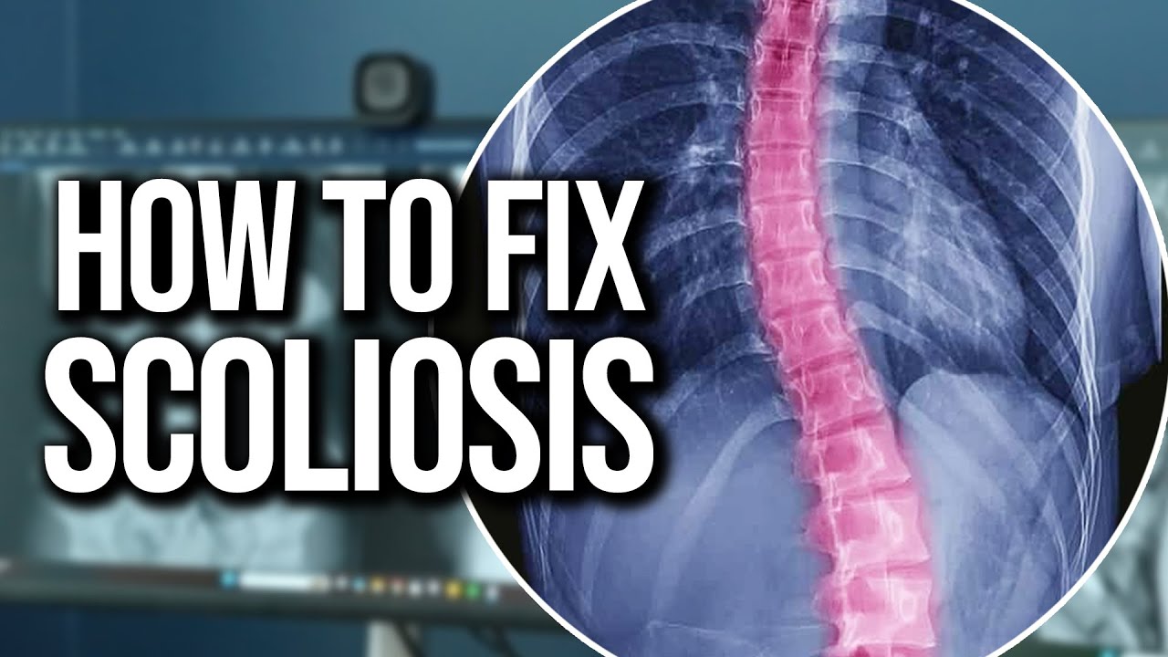 How Adult Scoliosis Is Treated