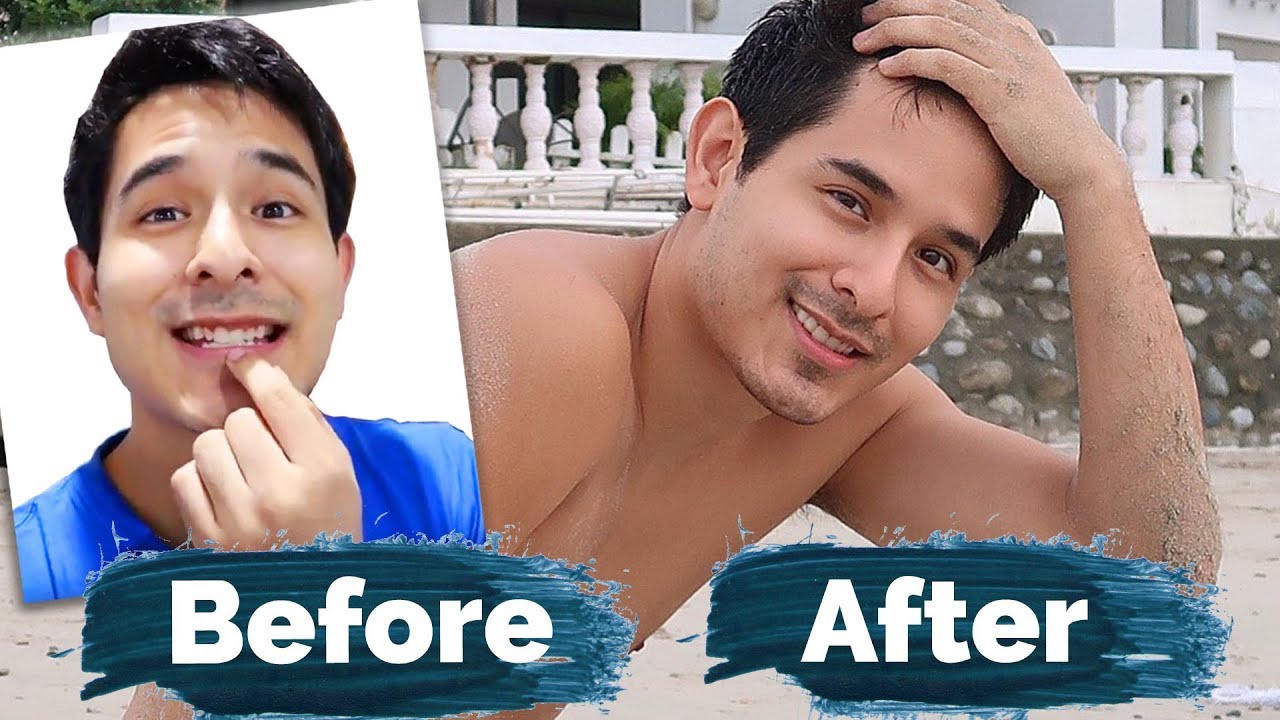 The Secret To Perfect Teeth: Veneers