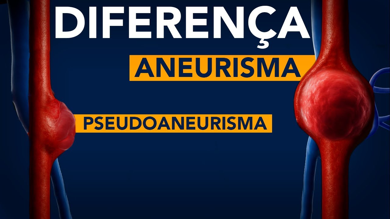Diferença entre aneurisma e pseudoaneurisma